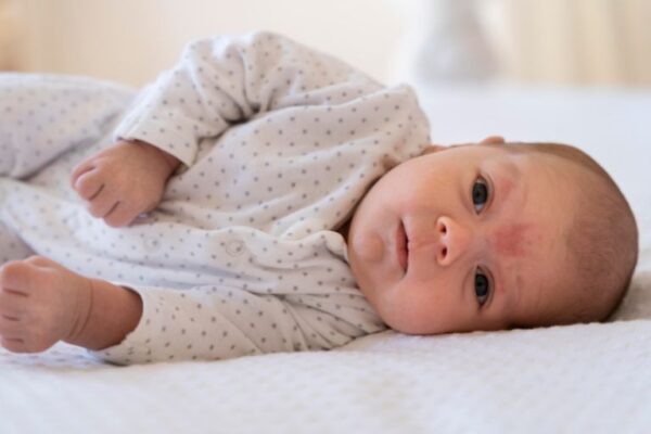 Promene na koži novorođenčeta