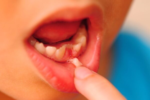 povrede mekih tkiva usne duplje