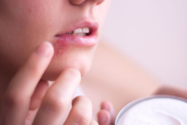 Stomatitis je zapravo zapaljenje sluzokože u ustima. 