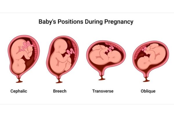 beba treba da okrene glavu nadole