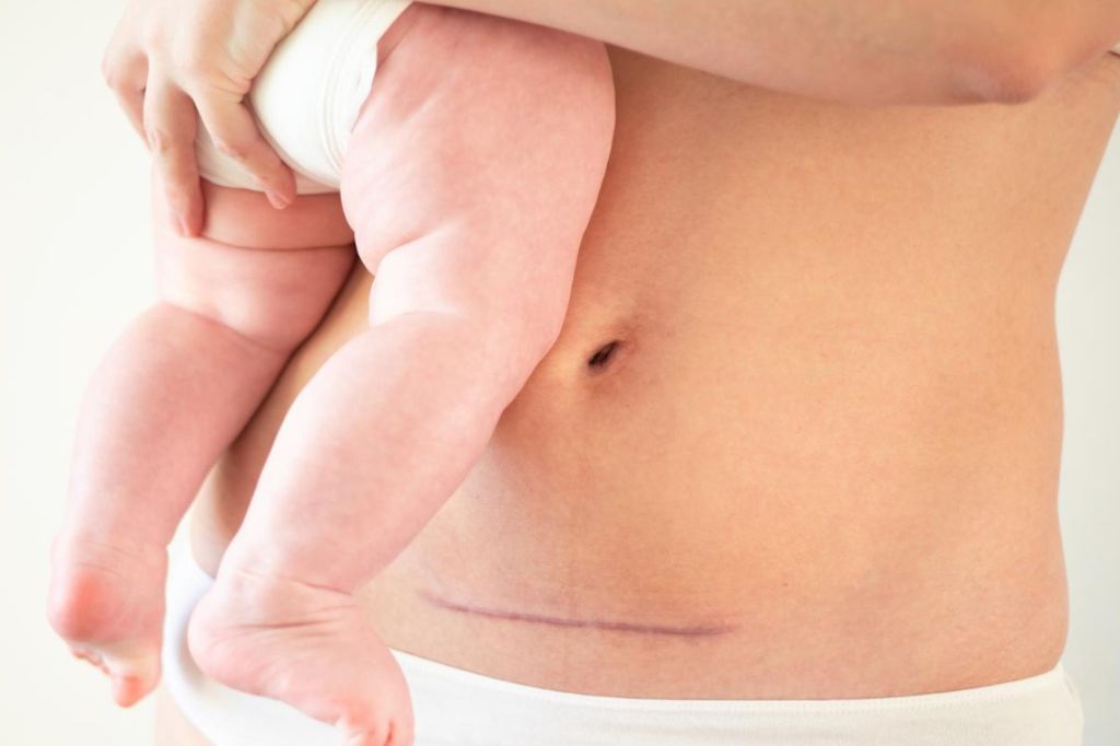 Posledice ožiljka od carskog reza