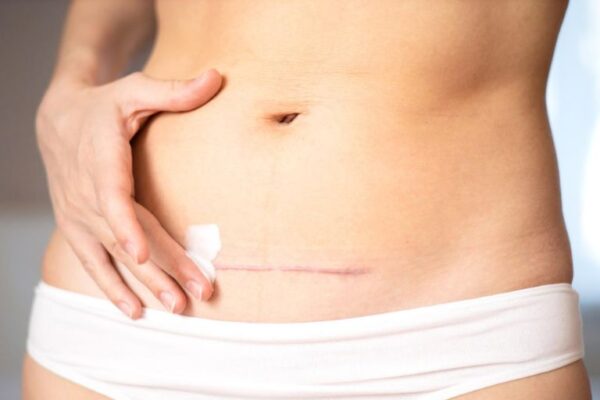 Posledice ožiljka od carskog reza