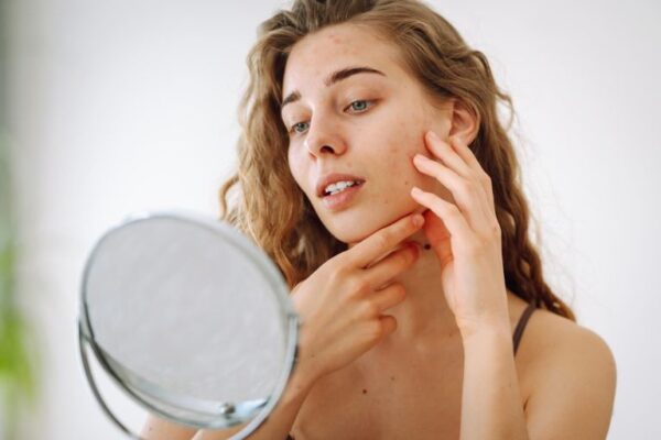 Acne Plus losion