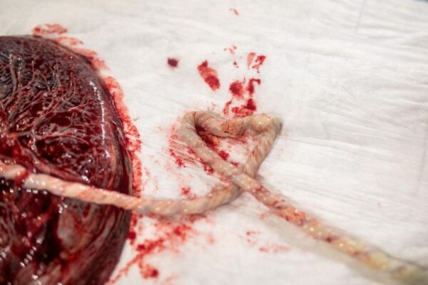 Placenta u modernoj medicini 